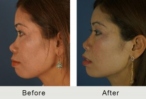 AntesDespués-Rinoplastia-no-quirúrgica-lado-lrg