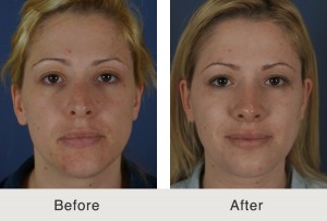 Kulbersh-Rhinoplasty1-1-20-15