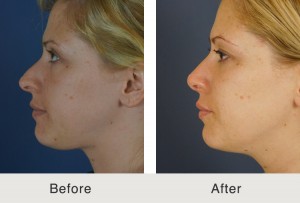 Kulbersh-Rhinoplasty2-1-20-15