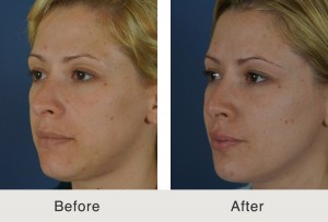 Kulbersh-Rhinoplasty4-1-20-15