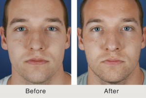 Kulbersh-Charlotte-Rinoplastia-Joroba2-grande