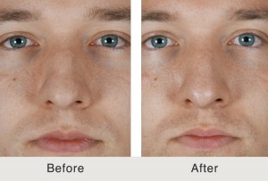 Kulbersh-Charlotte-Rinoplastia-Joroba4-grande