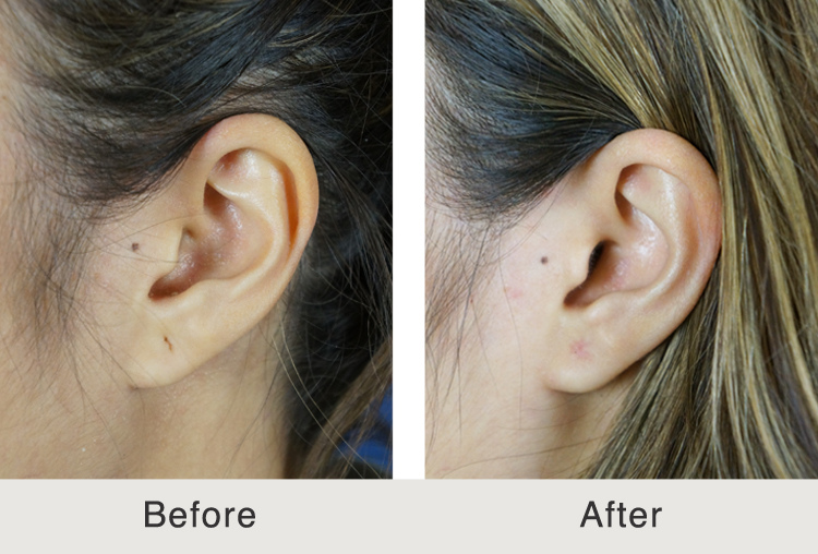 Charlotte Torn Earlobe Treatment