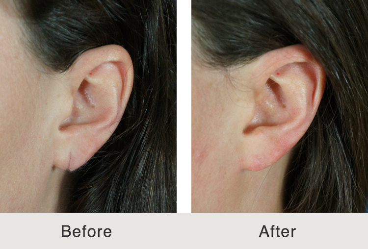 Carolina Facial Plastic Ear Reconstruction