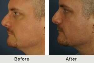 BeforeAfter-40yroldLiposuction to Neck-left-1-8-16