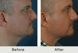 BeforeAfter-40yroldLiposuction to Neck-right-1-8-16