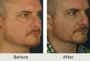 BeforeAfter-40yroldLiposuction to Neck-right-angle-1-8-16