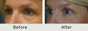 BeforeAfter-51 yo Quad Bleparoplasty-angle-closeup-1-8-16