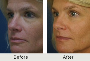 BeforeAfter-51 yo Quad Bleparoplasty-angle-left-1-8-16