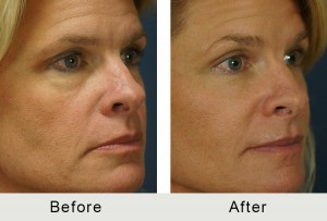 BeforeAfter-51 yo Quad Bleparoplasty-angle-right-1-8-16