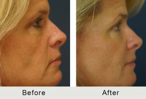 BeforeAfter-51 yo Quad Bleparoplasty-left-1-8-16