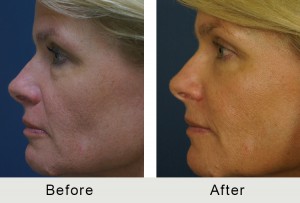 BeforeAfter-51 yo Quad Bleparoplasty-right-1-8-16
