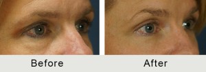 BeforeAfter-51 yo Quad Bleparoplasty-right-closeup