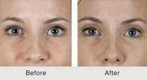 FemaleFiller-Eyelids-Temples-Jawline2-large