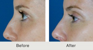 FemaleFiller-Eyelids-Temples-Jawline4-large