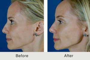 FemaleFiller-Eyelids-Temples-Jawline7-large