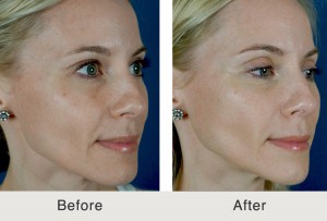 FemaleFiller-Eyelids-Temples-Jawline8-large