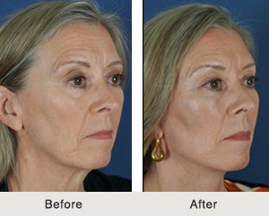 Kulbersh-Charlotte-Estiramiento facial-Relleno8-pequeño