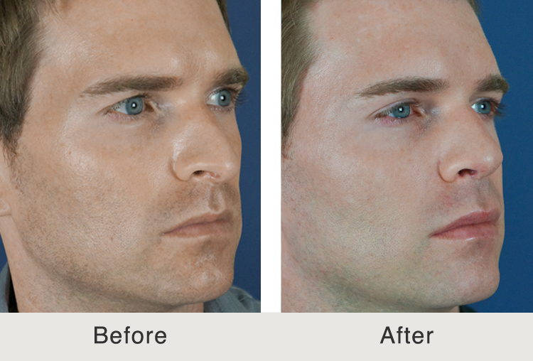 Before & After: Male Filler, Temples and Tear Trough - Carolina Facial ...