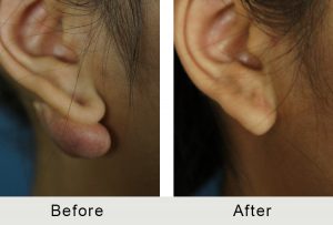 Before and After Female Charlotte Keloid Removal