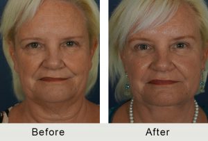 BeforeAfter-Charlotte Endoscopic Browlift facelift necklift-front- 3-21-2016