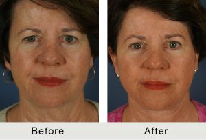 BeforeAfter-Neck Lift Eyelid lift and 1cm browlift-front-1-8-16