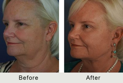 Charlotte Facelift Plastic Surgery