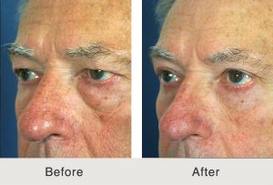 Quad Blepharoplasty to Eliminate Undereye Bags in Charlotte