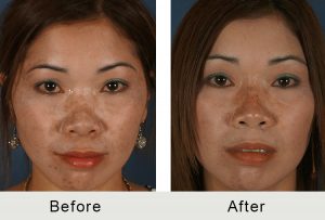 BeforeAfter-Non-surgical-rhinoplasty-front-lrg
