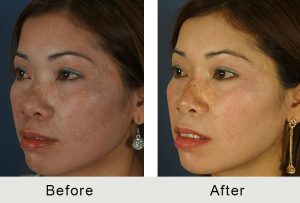 BeforeAfter-Non-surgical-rhinoplasty-reverse-angle-lrg
