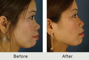 Before and After: Non-Surgical Rhinoplasty