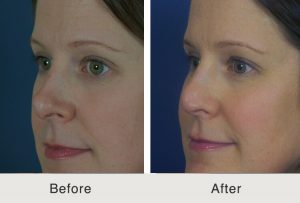 Kulbersh-revision-rhinoplasty-4-21-17