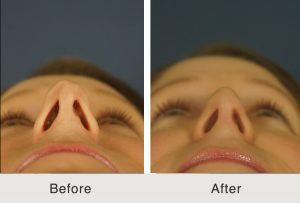 Kulbersh-revision-rhinoplasty5-4-21-17