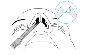 rhinoplasty nose surgery diagram from a charlotte plastic surgeon