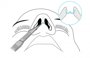 A Key Support Graft During A Rhinoplasty The Columellar Strut A Key Support Graft During A Rhinoplasty The Columellar Strut