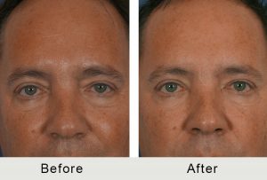 Men Injectable Facial Treatment Charlotte 