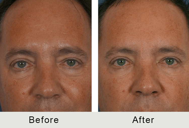 Charlotte Men Injectable Facial Treatment