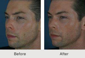 Kulbersh-before-after-6-12-17-4