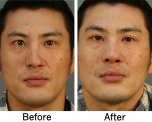 asian nose job before and after