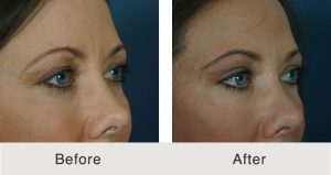 Charlotte Upper Blepharoplasty Surgery