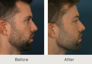 Male Facial Plastics charlotte