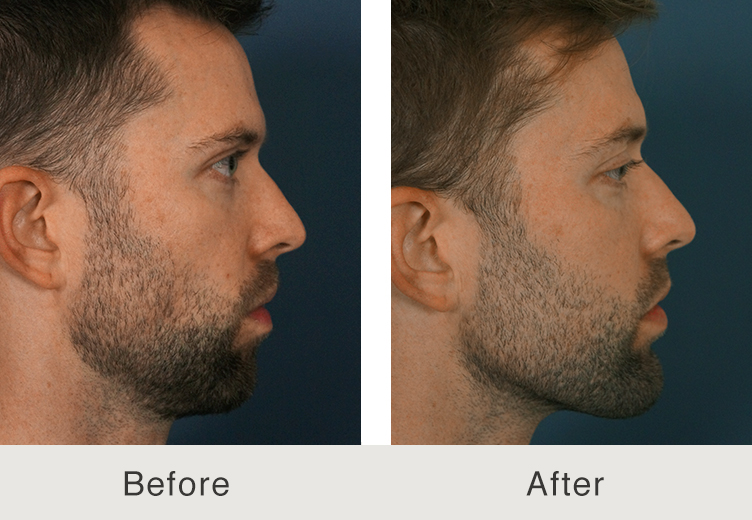 The Rise of Jawline Fillers for Men - The Cosmetic Skin Clinic