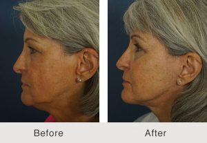 cheek-implants-2