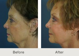 estiramiento facial-2