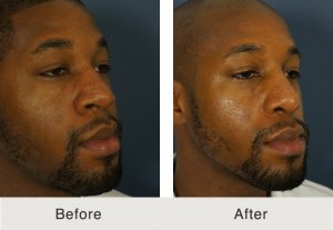 Kulbersh-male-african-rhinoplasty-1-9-20-17