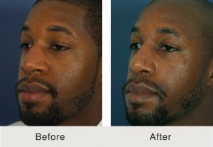 Kulbersh-male-african-rhinoplasty-5-9-20-17