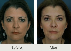 Best-Facelift-Charlotte-2