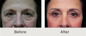endo-brow-quad-blepharoplasty-3