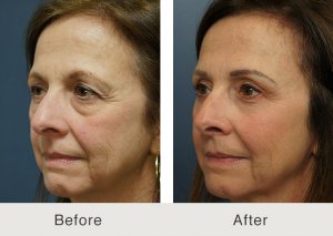 endo-brow-quad-blepharoplasty-4