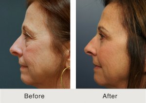endo-brow-quad-blepharoplasty-5